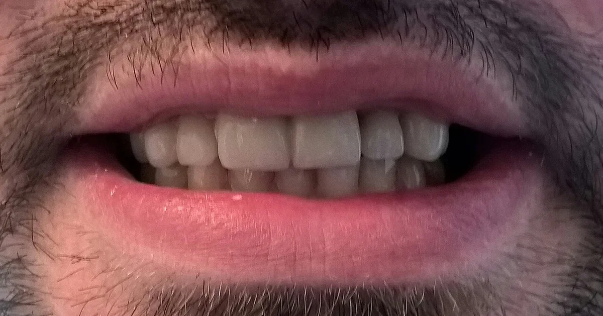 Sourire d’un patient portant des couronnes en zircone sur les dents antérieures du maxillaire supérieur