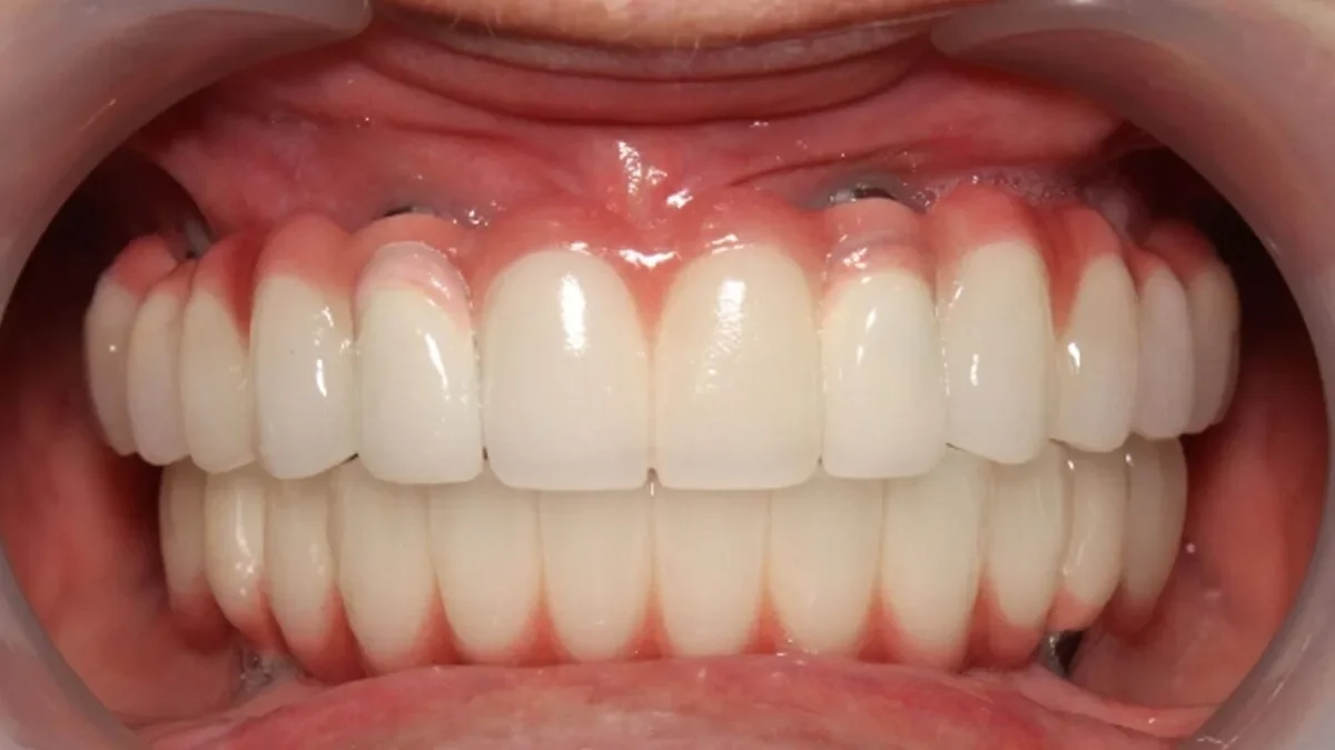 Dentier fixe complet sur implants de type All-on-4 posé sur les deux mâchoires après réhabilitation