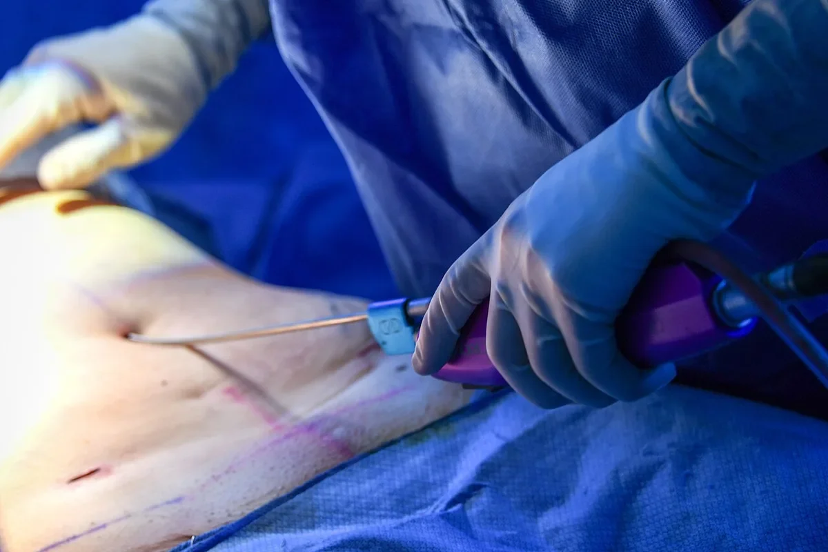 Cannula motorizzata inserita nell'addome durante una liposuzione assistita (PAL) in sala operatoria