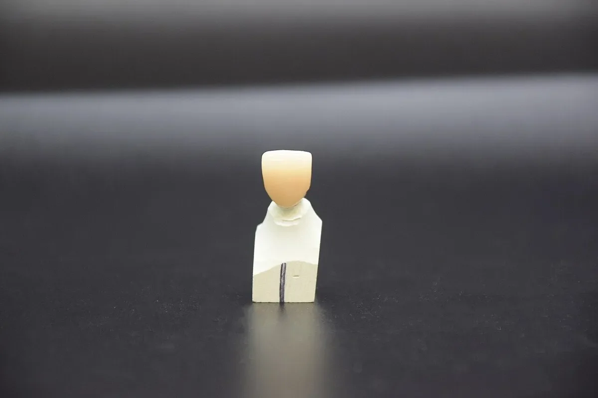 Corona dentale singola in zirconia per dente anteriore montata sul modello in gesso del laboratorio