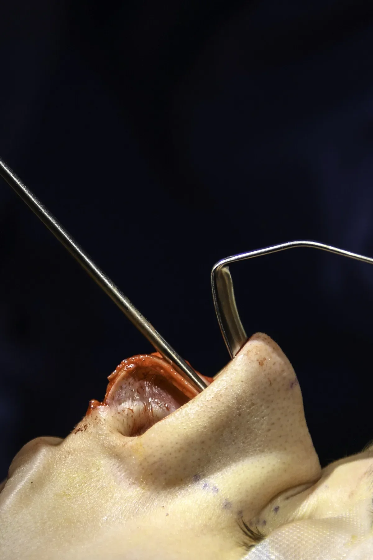 Chirurgo che solleva i tessuti molli del naso con aspiratore durante una rinoplastica aperta