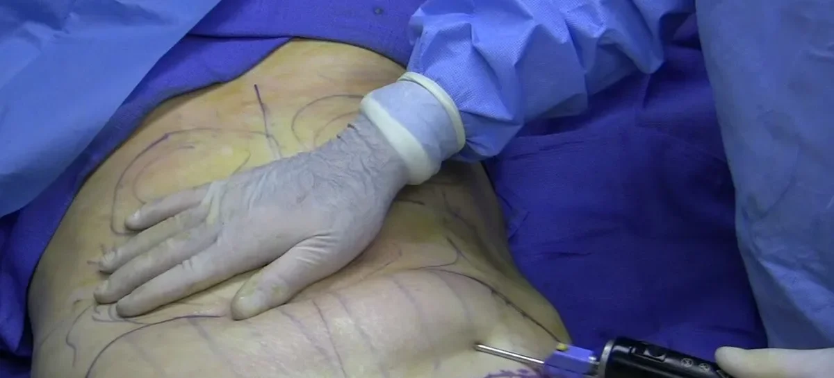 Prelievo di grasso con cannula dall'addome, prima fase del BBL o lipofilling dei glutei