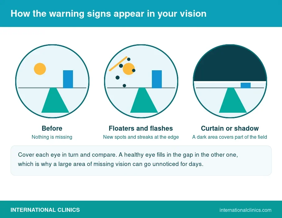 Three circles showing normal vision, then new floaters and flashes, then a dark curtain covering part of the visual field