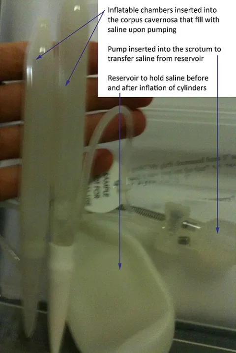 Penile implant Turkey: three-piece inflatable penile prosthesis with cylinders, pump and reservoir