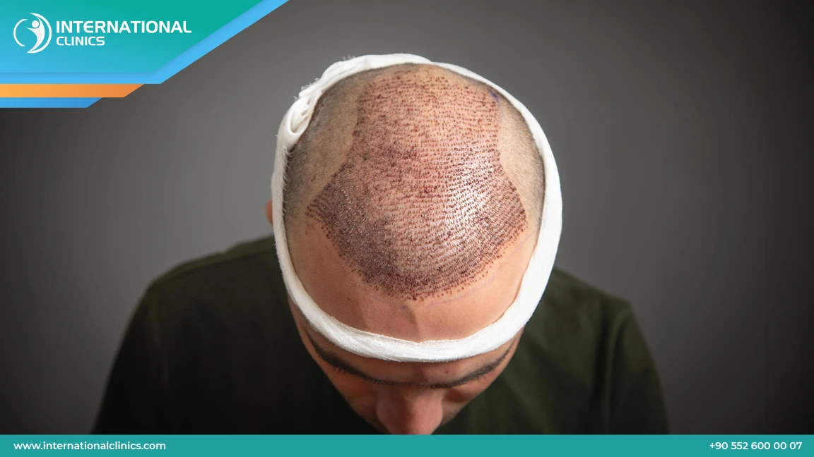 عمليات زراعة الشعر: أفضل التقنيات وتفاصيل الخطوات والنتائج 