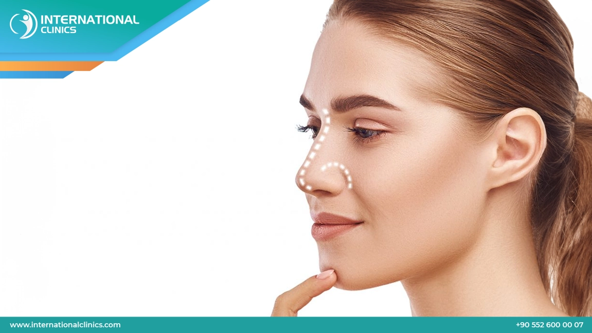 مقارنة تكلفة عملية تجميل الأنف بين تركيا ومختلف دول العالم 2025