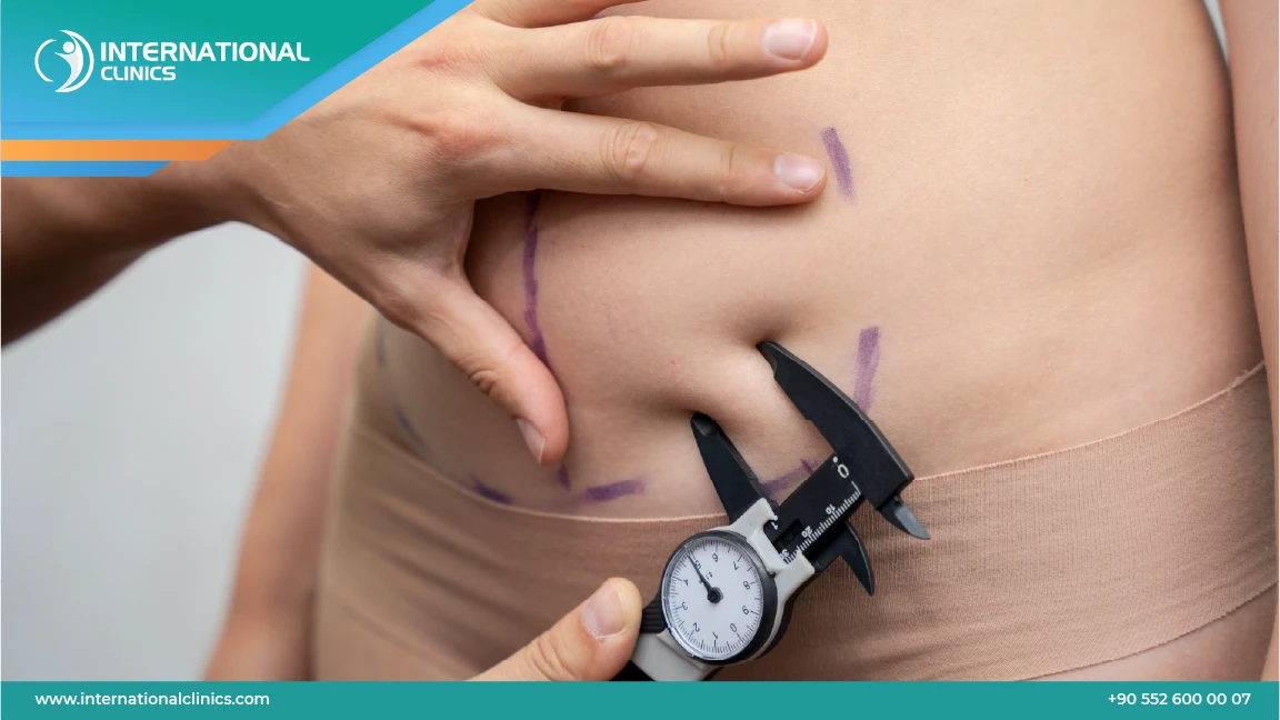 عملية شد البطن في تركيا بأحدث الطرق 2025 