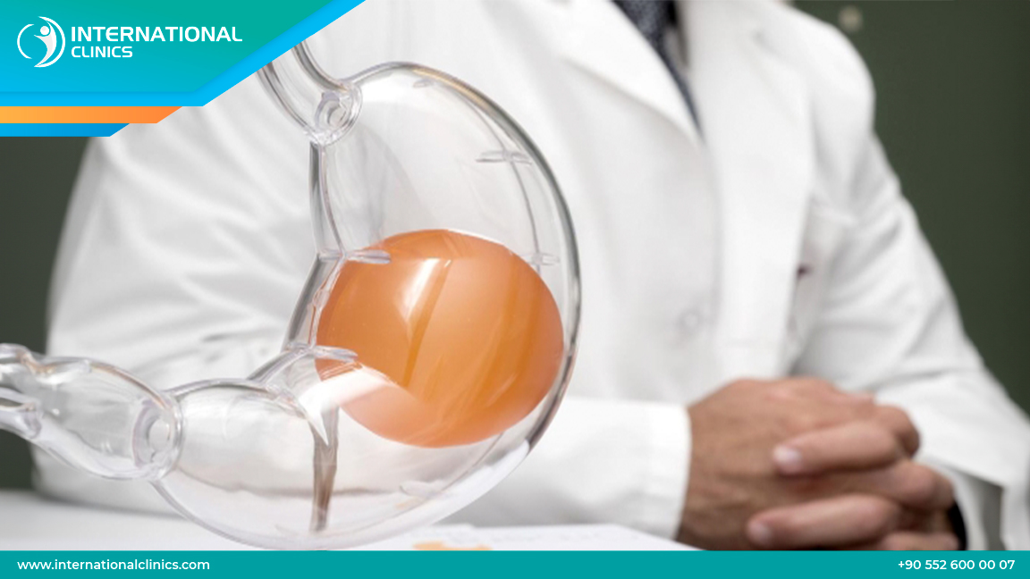  عمليات بالون المعدة في تركيا : المميزات والتكاليف والنتائج 2025