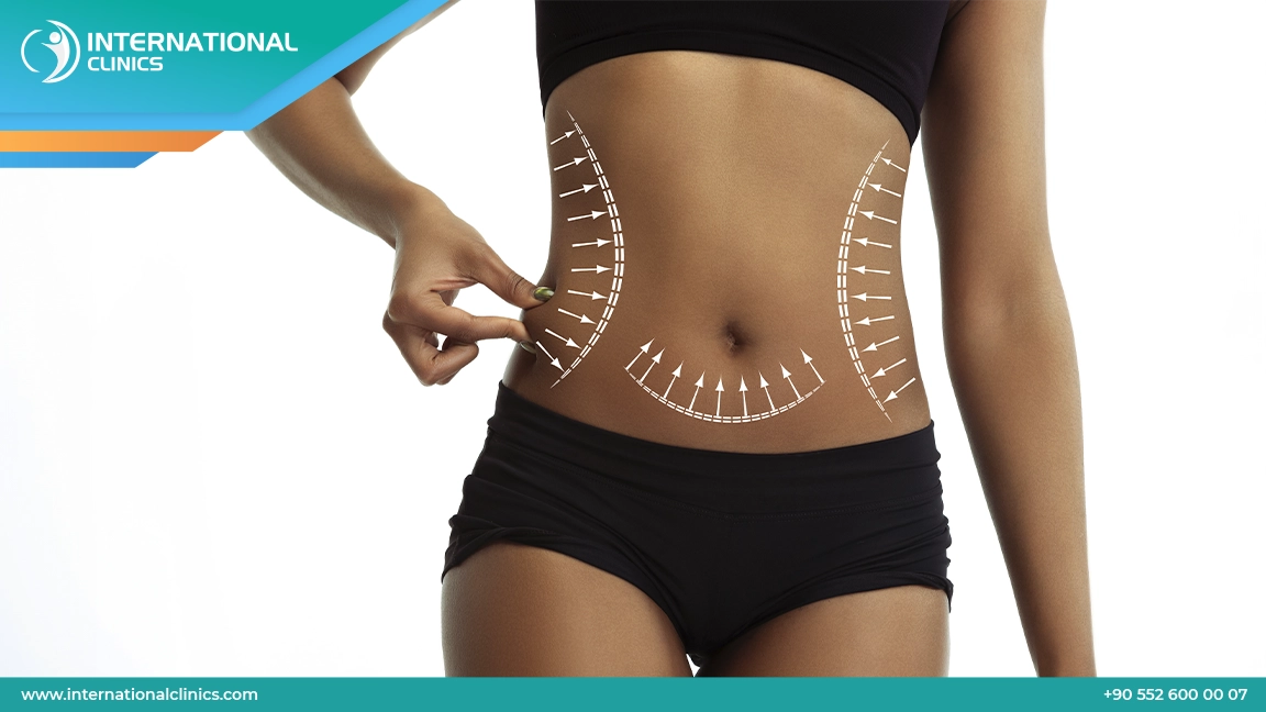 عملية شفط دهون البطن في تركيا 2024 | International Clinics