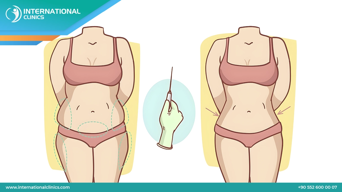 شفط الدهون بالفيزرفي تركيا: أحدث التقنيات 2025