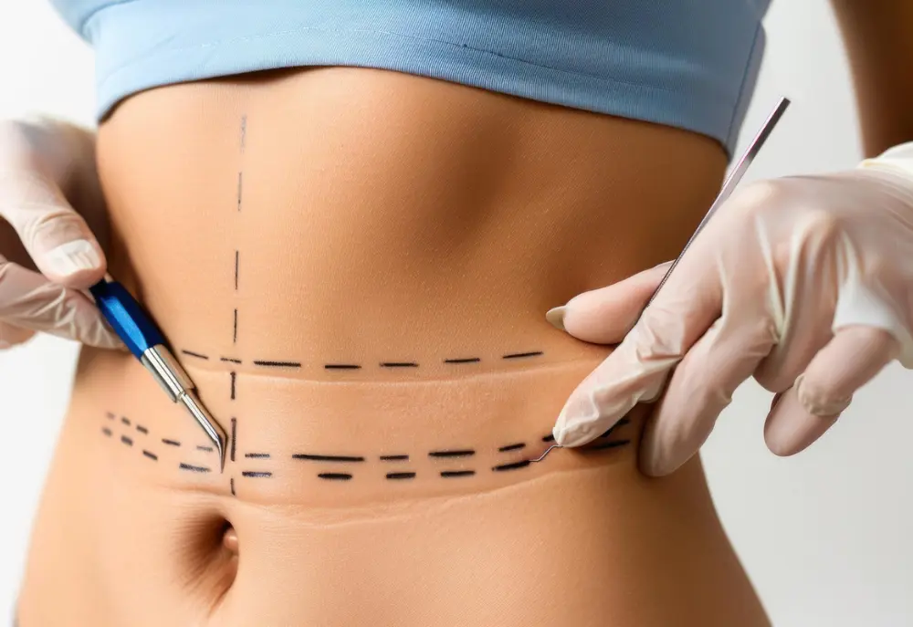 What is Vaser Liposuction? Sculpting Your Ideal Look