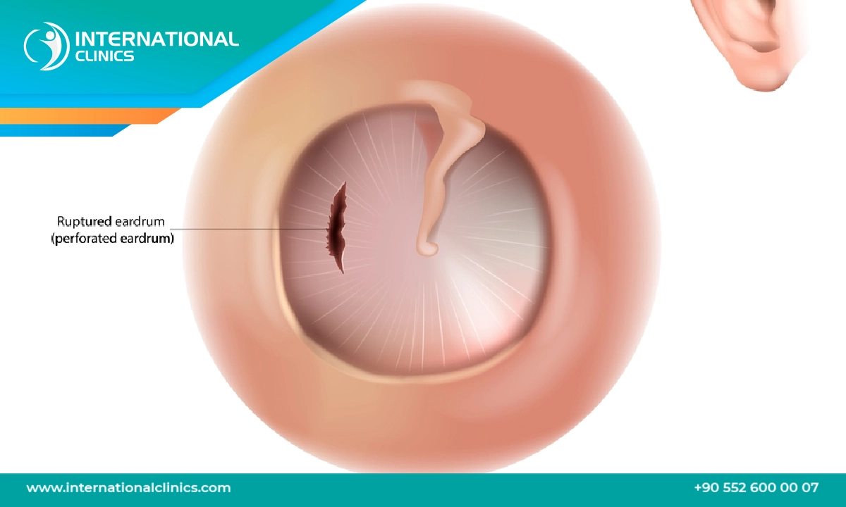 تمزق طبلة الأذن: الأسباب والأعراض وطرق العلاج 2024