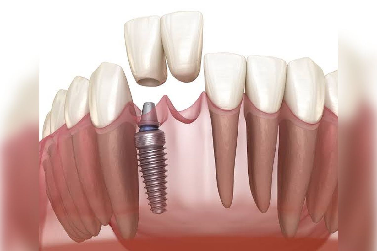 Implant-Supported Bridges: Benefits, Costs and  How They Work