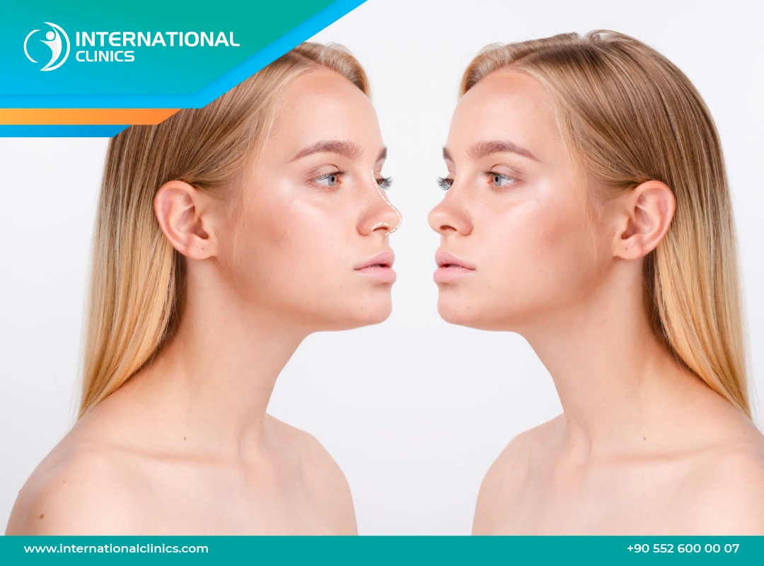 Rhinoplastie en Turquie : Transformez votre regard sur la chirurgie esthétique