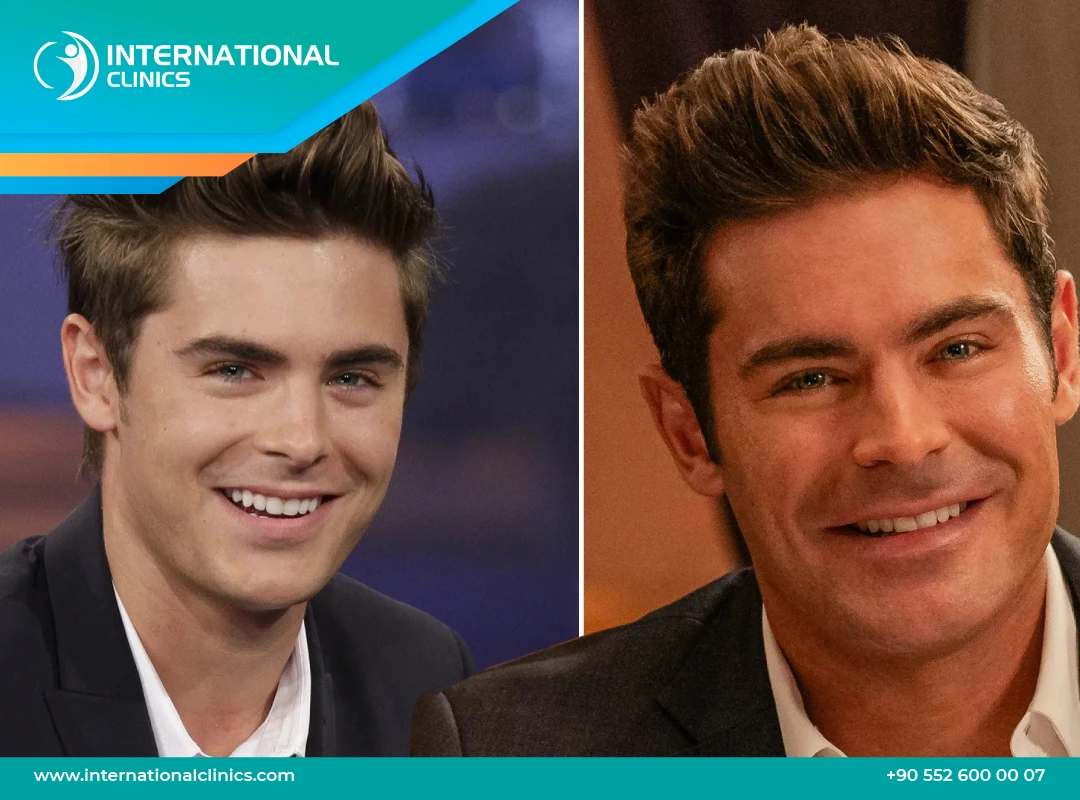 Did Zac Efron Get Plastic Surgery: The Truth Behind His Changing Look