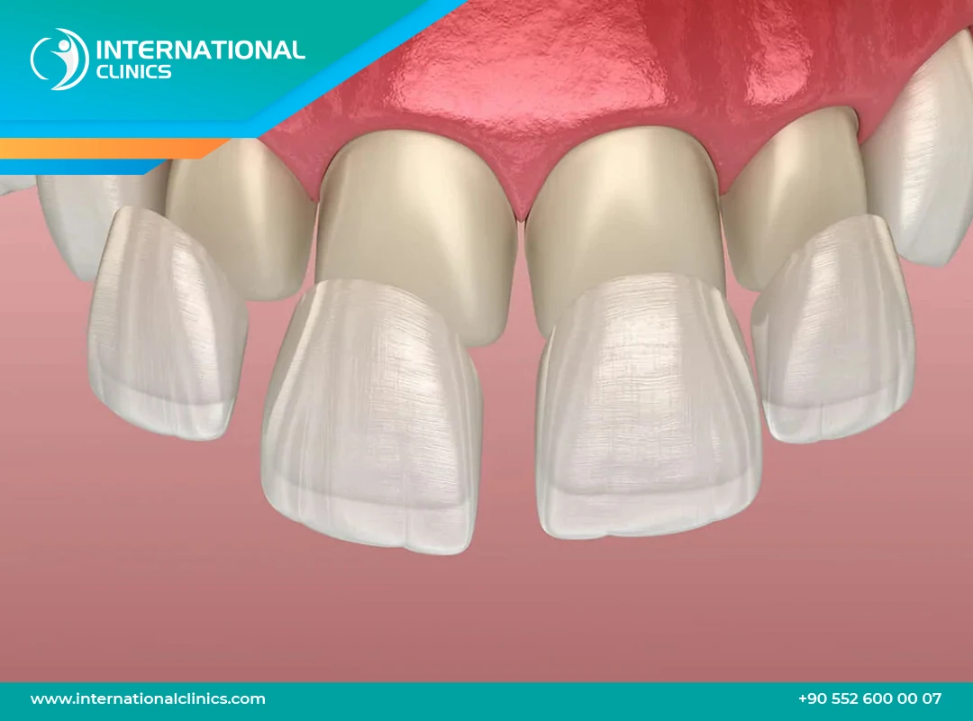 تلبيس الأسنان في تركيا: الأسعار والأنواع والخطوات 2025