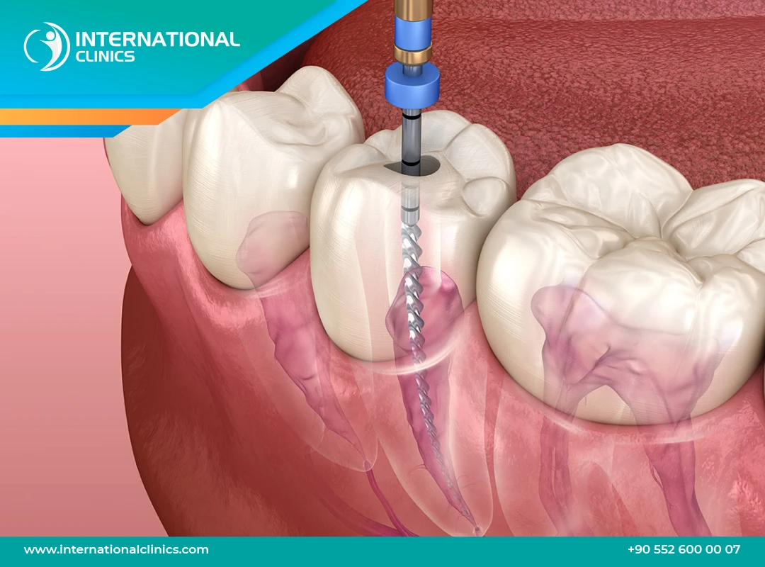 علاج عصب الأسنان:احصل على علاج فوري وفعال