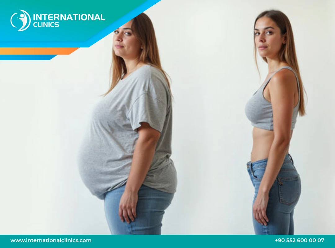 Gastric Sleeve Cost in Turkey: Affordable Weight Loss Surgery