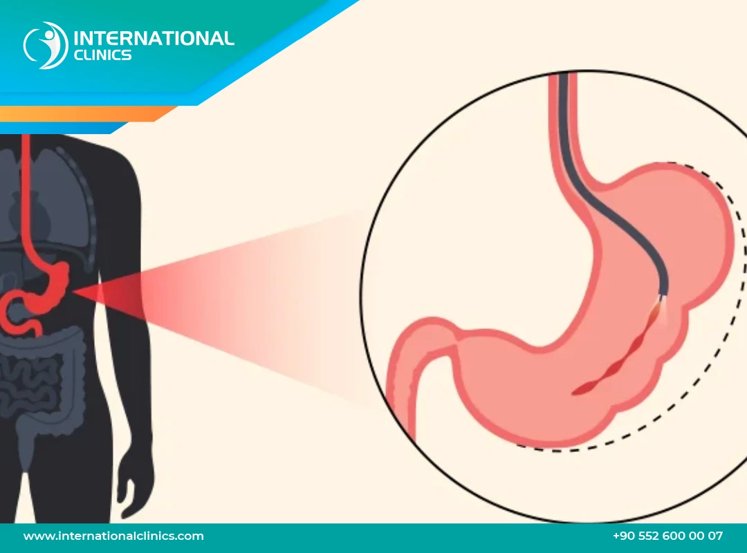 Endoscopic Sleeve Gastroplasty: Make Safe & Affordable choice