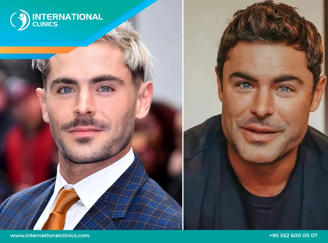 Zac Efron et la chirurgie : Explications liées à sa transformation