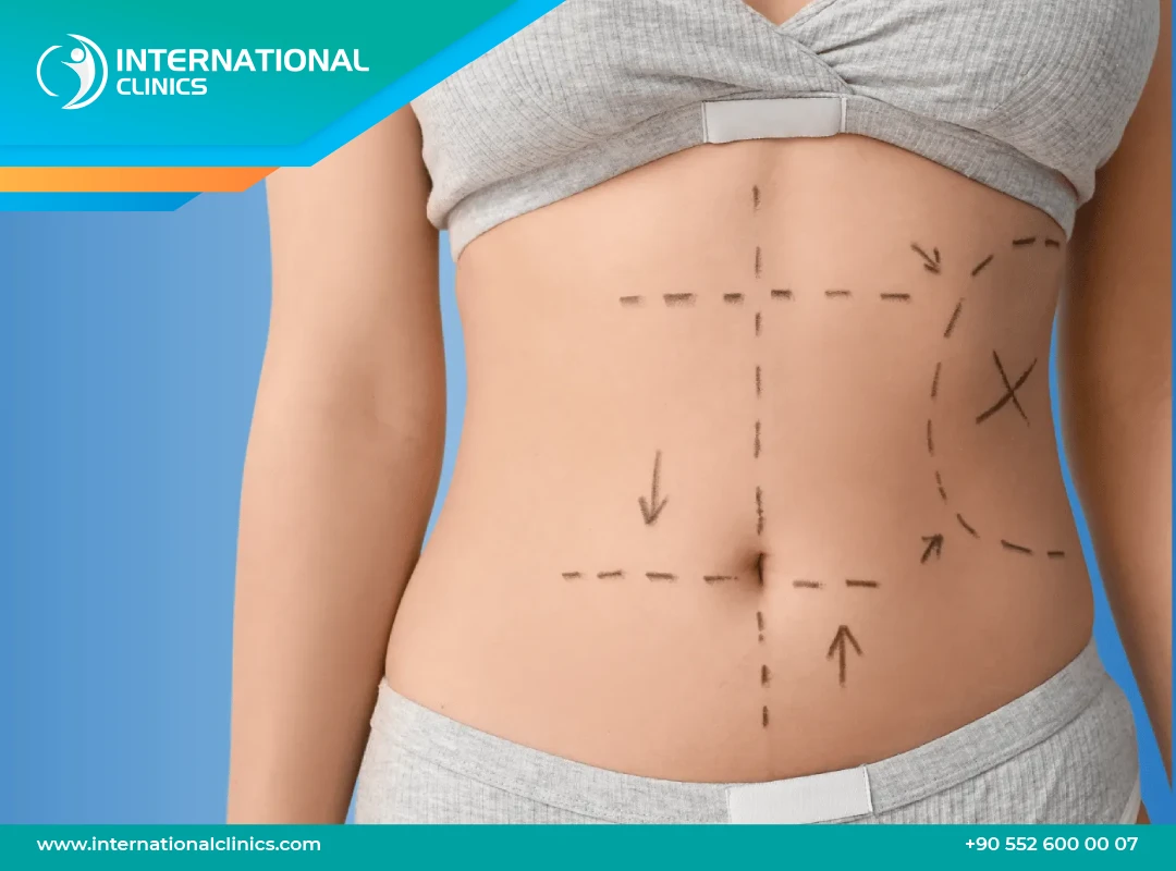 Abdominoplastie 10 ans après : Choisir nos cliniques en Turquie pour des résultats durables 2025