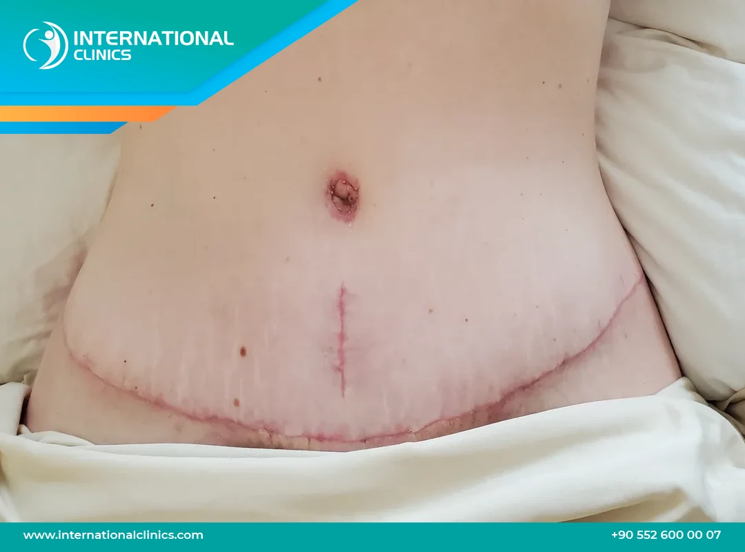 Abdominoplastie ratée : Risques et solutions avec nos cliniques internationales en Turquie