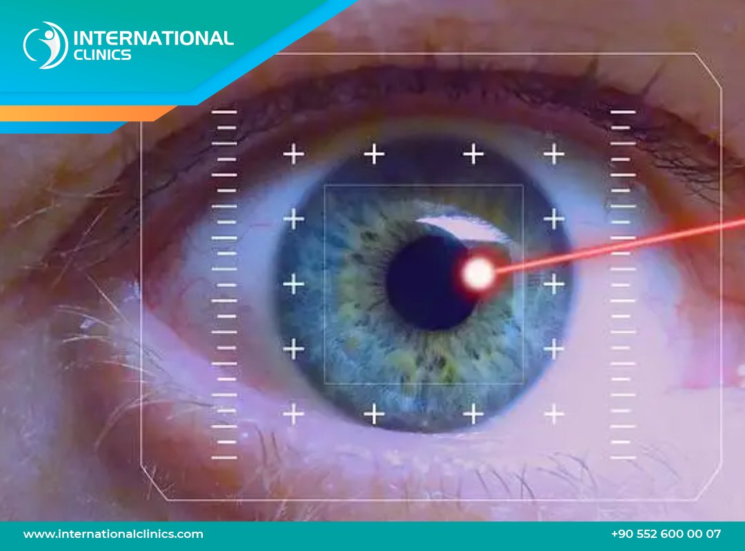 عملية تصحيح النظر بالليزر في تركيا: الانواع، الفوائد والاضرار والتكلفة