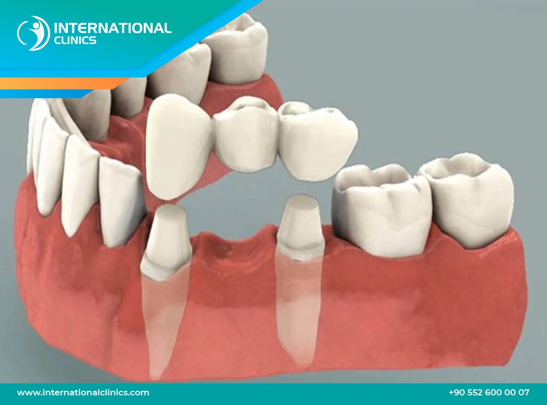Bridges dentaires en Turquie – Qualité & Prix abordables | International Clinics