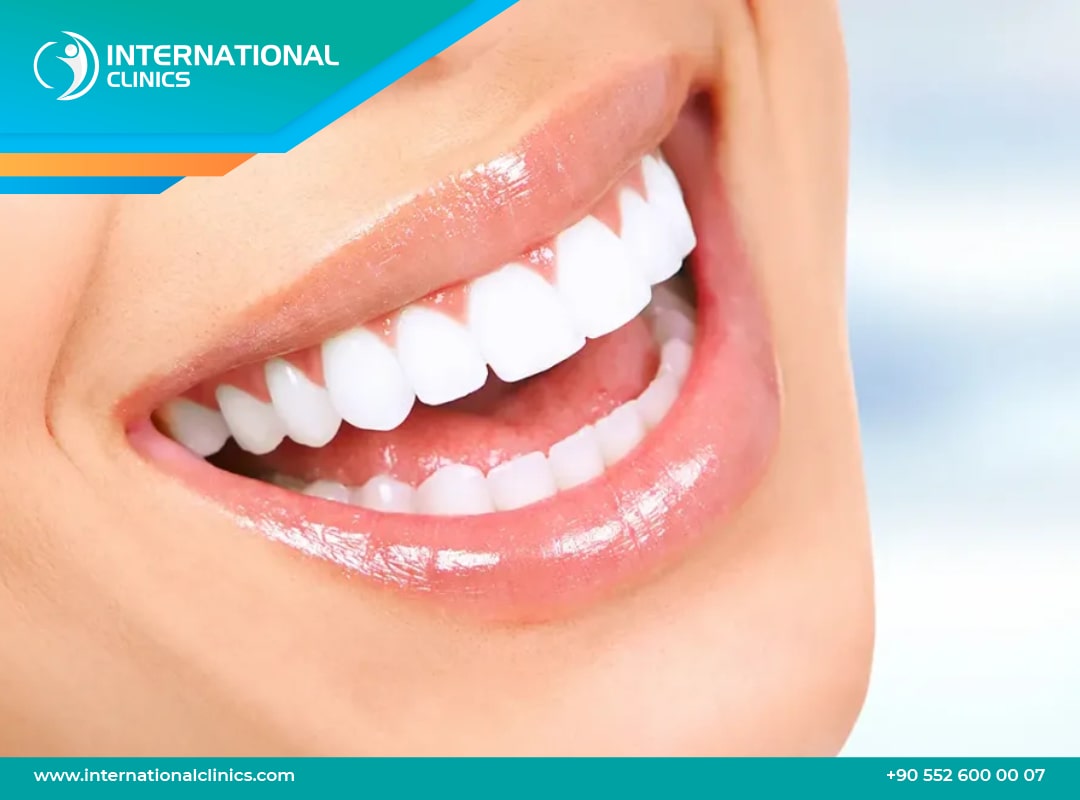 Bridge dentaire dent devant en Turquie | Prix abordable & qualité garantie