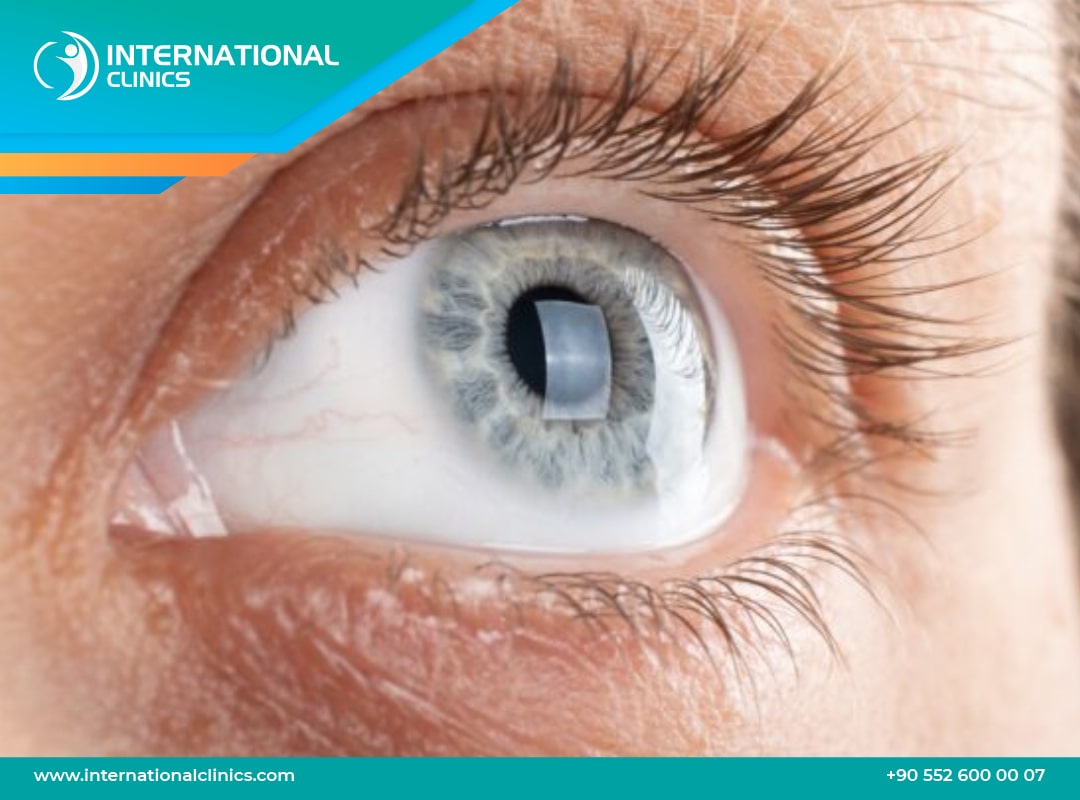 الممنوعات بعد زراعة القرنية ونصائح للتعافي السليم