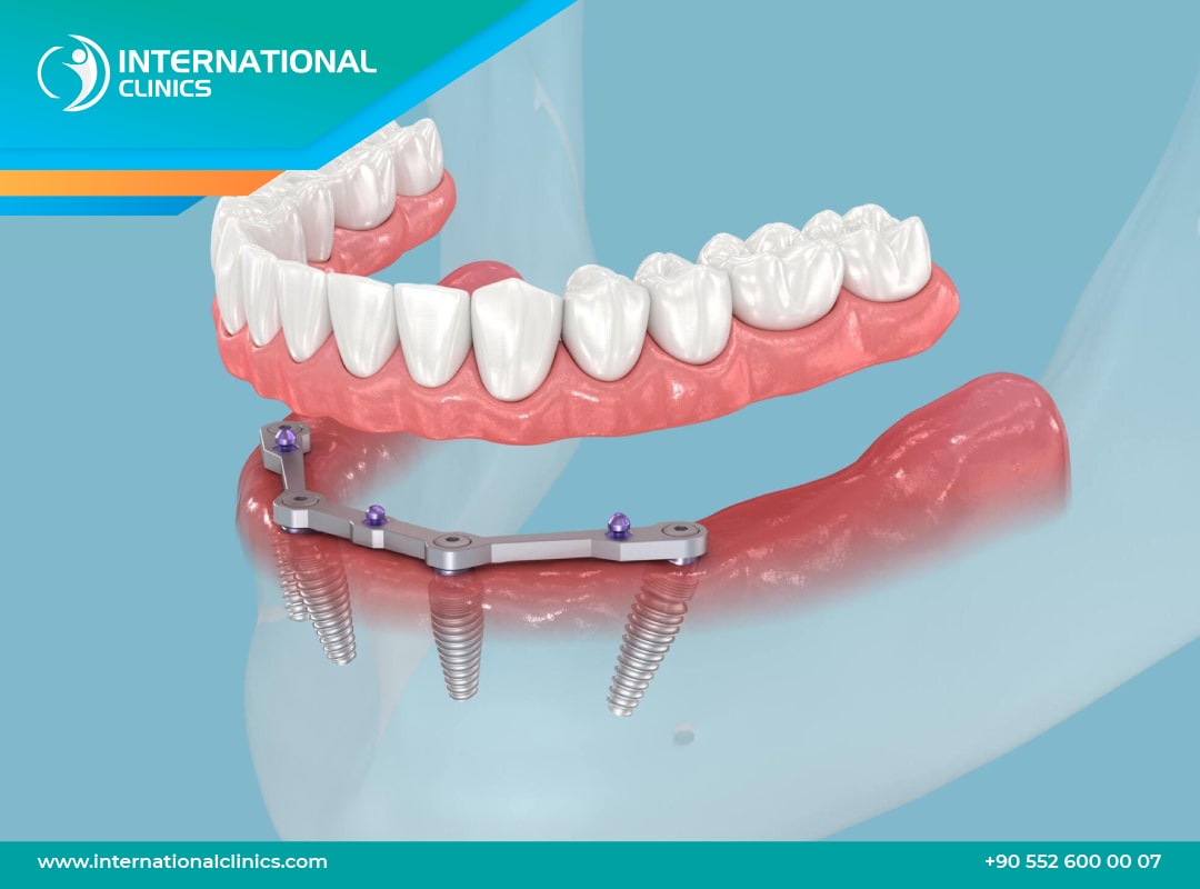 4 Implant dentaire prix en Turquie : La solution idéale avec International Clinics