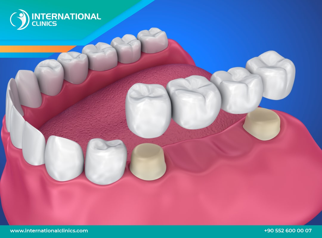 Informez-vous sur le prix du bridge dentaire : Nos solutions chez International Clinics