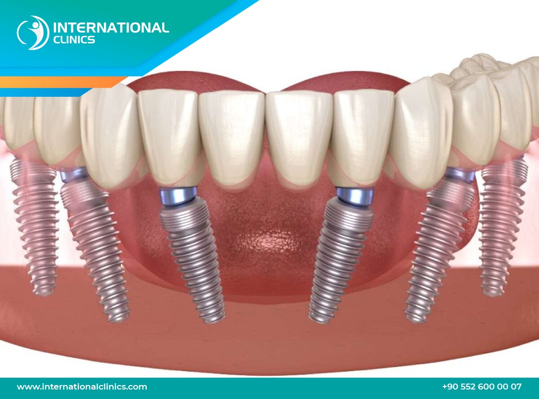 Prix bridge dentaire 6 dents en Turquie : Une solution abordable pour un sourire parfait