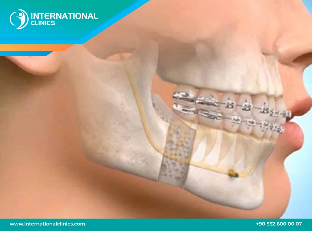 Chirurgie maxillo facial en Turquie | International Clinics