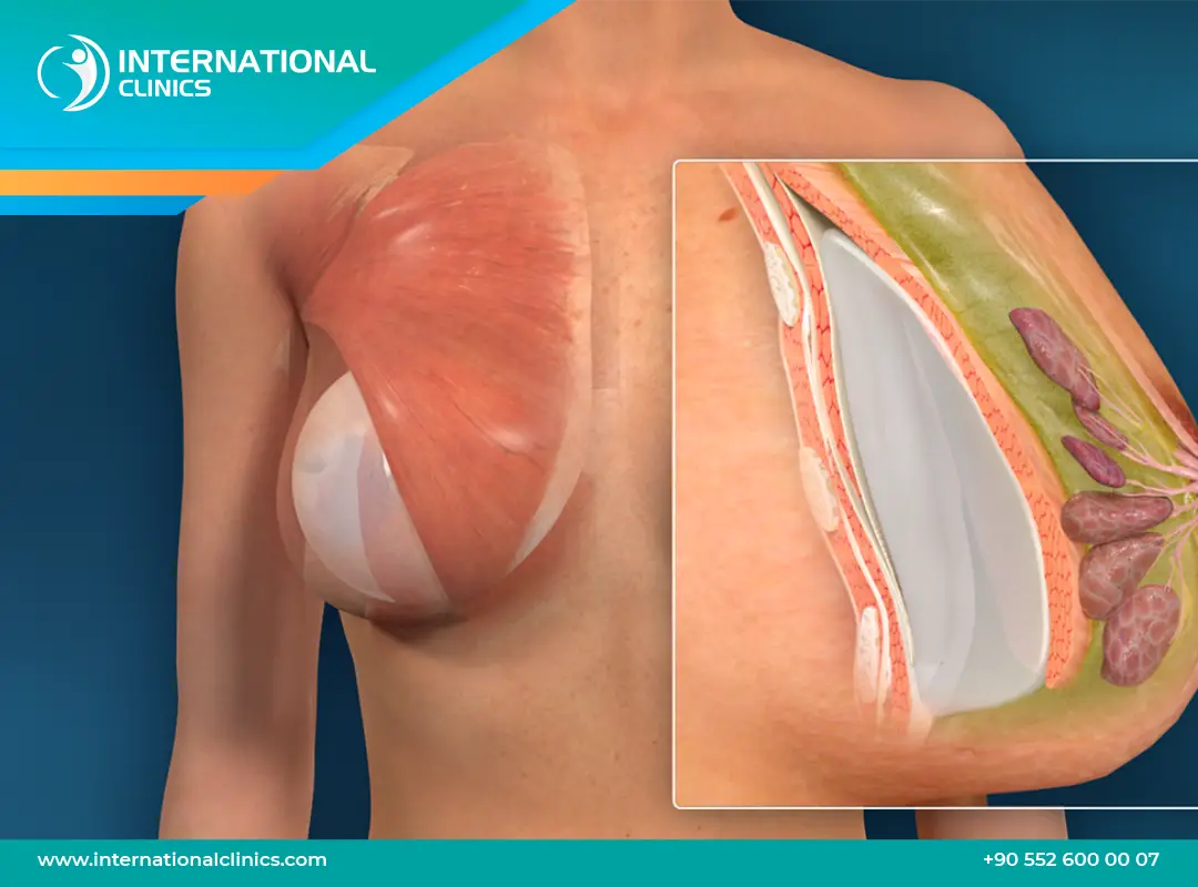 Breast Augmentation in Turkey | Best Clinics, Surgeons & Costs 2025 