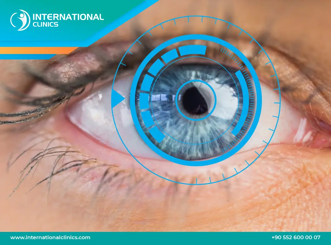 Smart Lens Surgery Turkey: Price, Types & Results (2025)