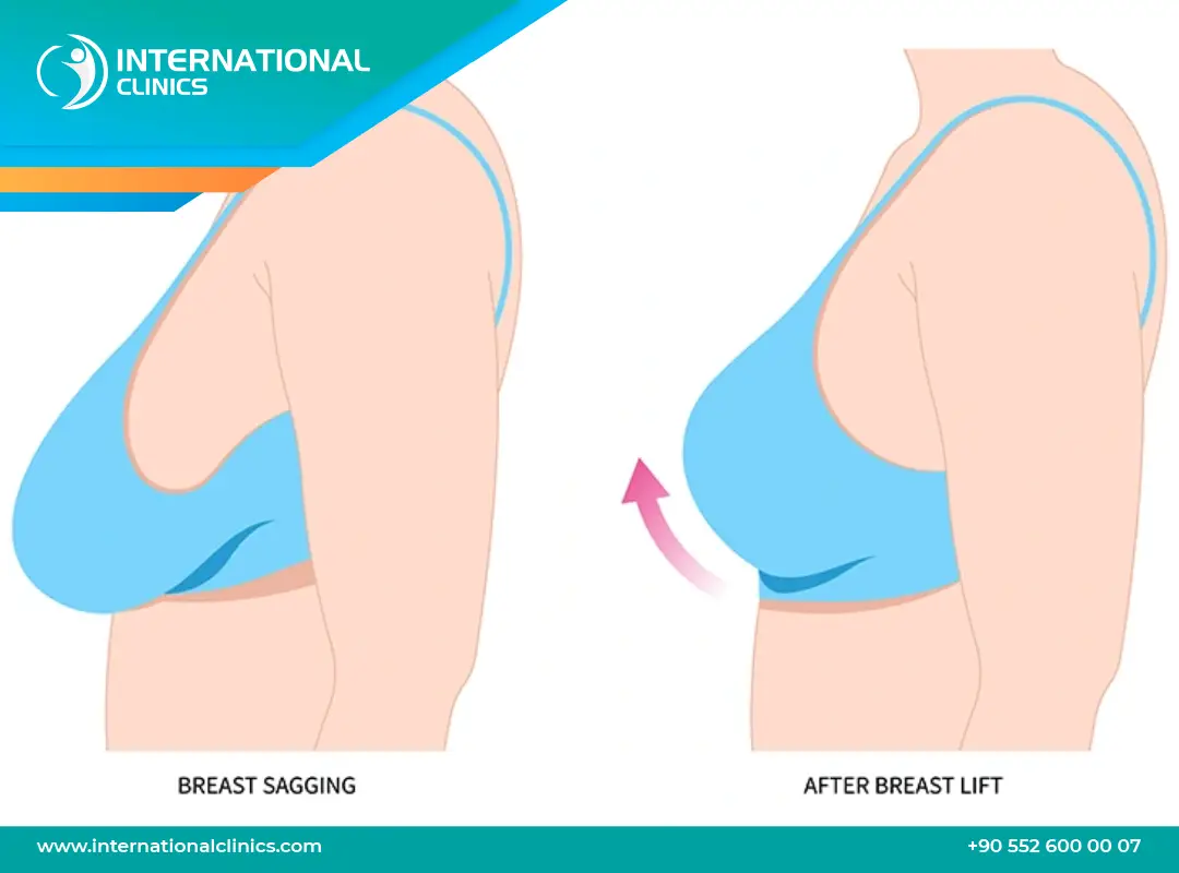 Breast Lift in Turkey: Types, Costs & Top Clinics