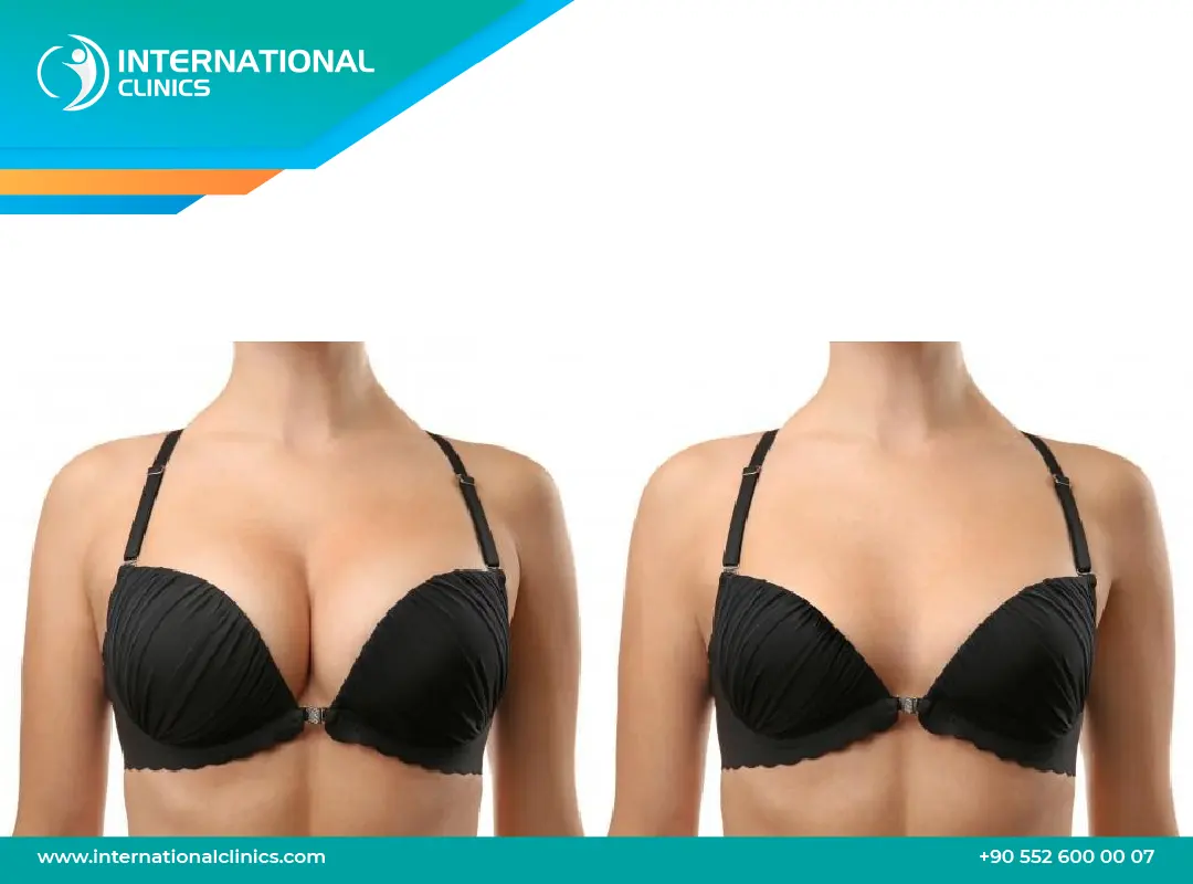 تصغير الثدي في تركيا: استعيدي ثقتك بجسم رشيق