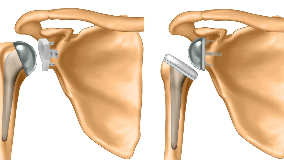 Total vs Reverse Shoulder Replacement: to All 8 Types