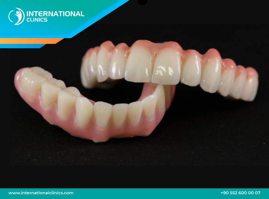 All-on-6 Dental Implants in Turkey  Affordable ,Safe, Permanent Smile