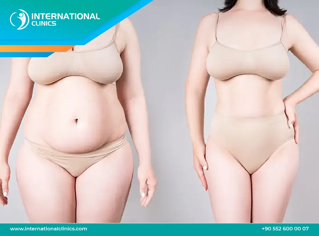 عملية شفط دهون البطن: إحصل على بطن مشدود وجذاب!