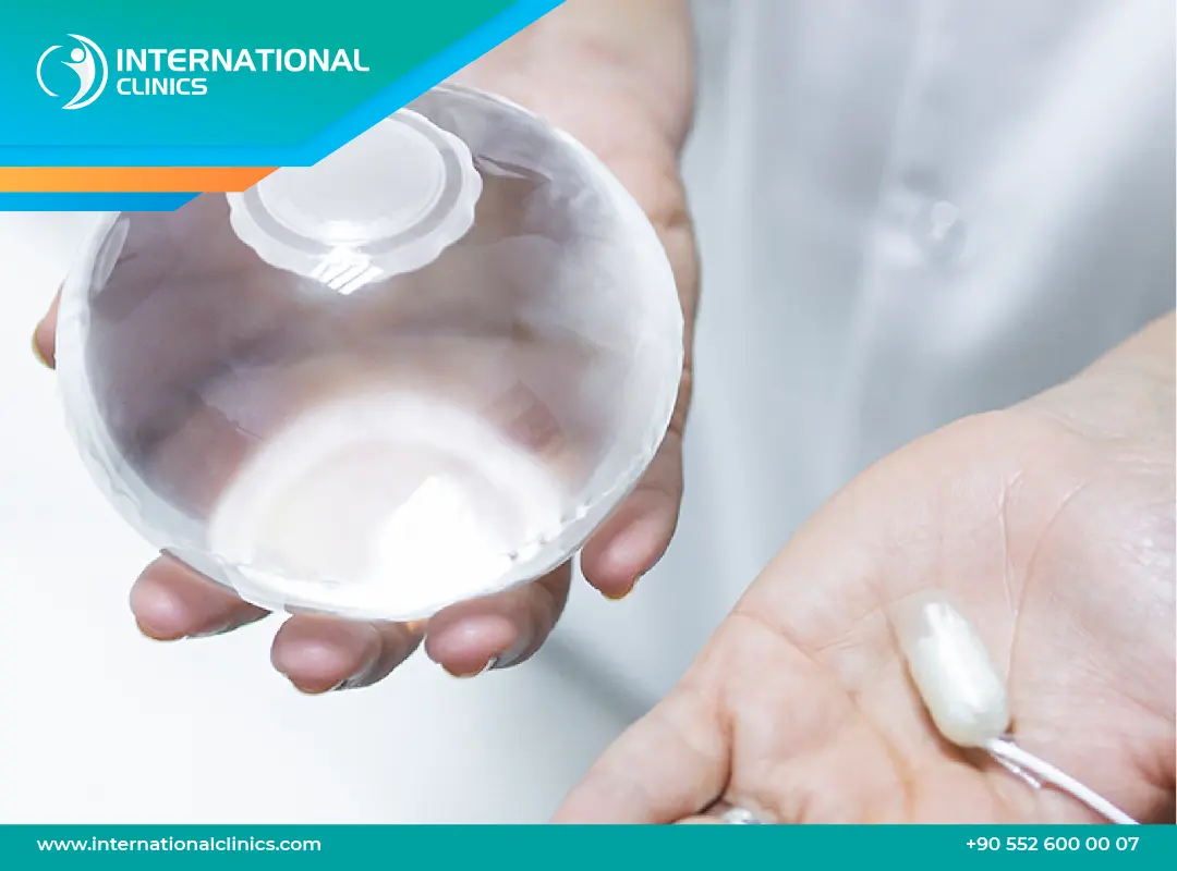 عملية بالون المعدة في تركيا: الحل الآمن لخسارة 15-20 كجم بدون جراحة