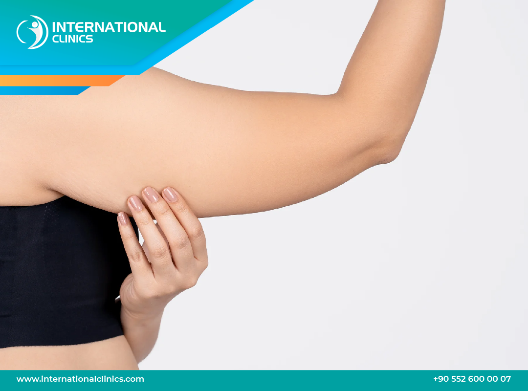 The Ultimate Guide to Arm Lift in Turkey: Cost, Procedure, and Recovery