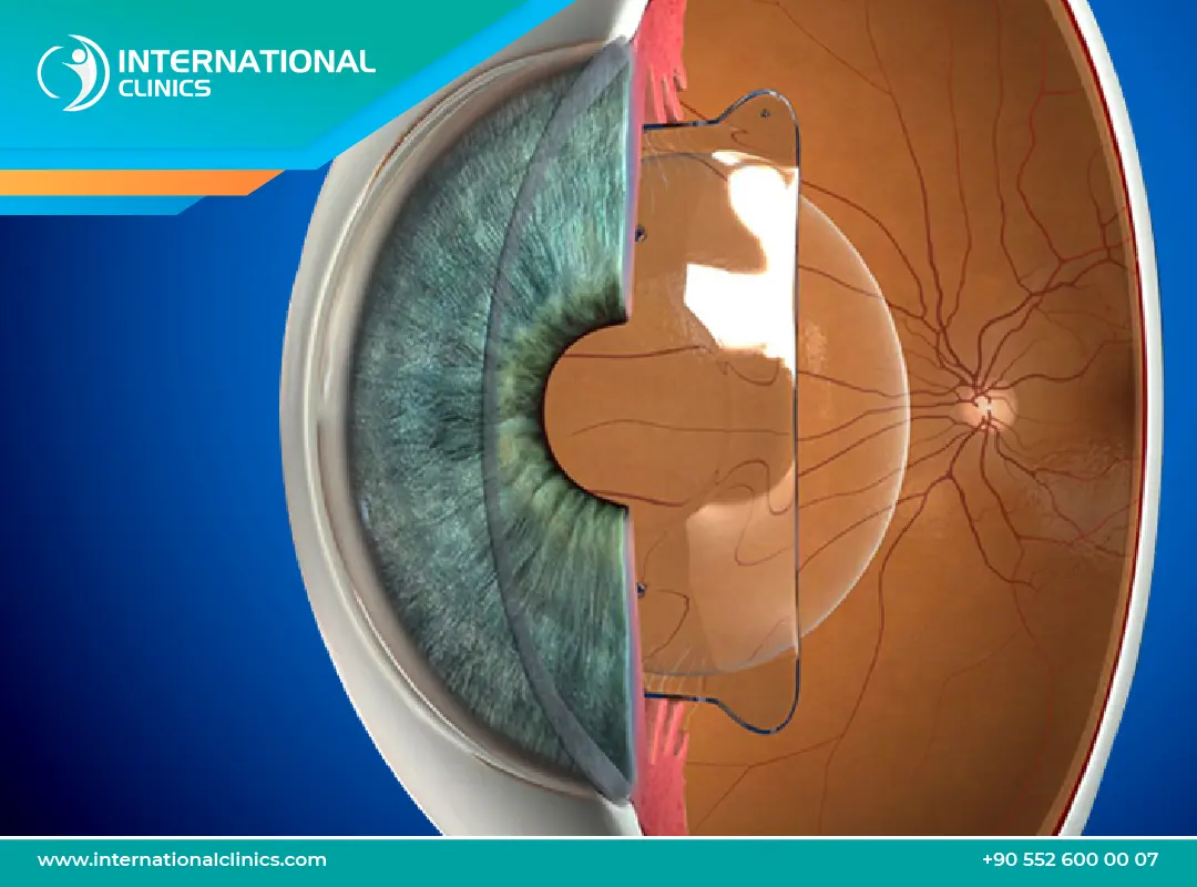 عملية زراعة عدسة العين في تركيا: بخطوات آمنة وتكلفة معقولة!