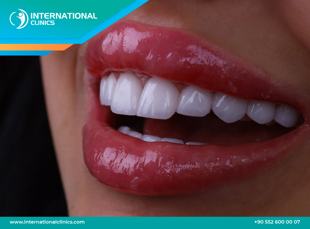 Hollywood Smile in Turkey – Enhanced Confidence with Flawless Smile