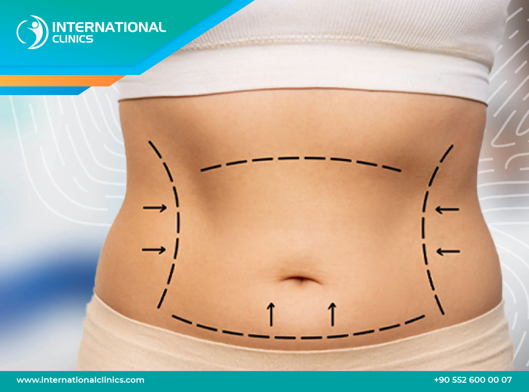 Is Lipo 360 Dangerous? The Risks o Body Contouring