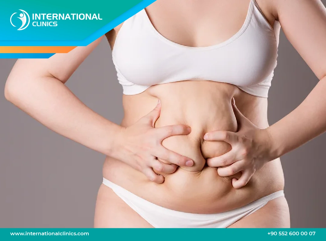 360 Lipo Without Tummy Tuck