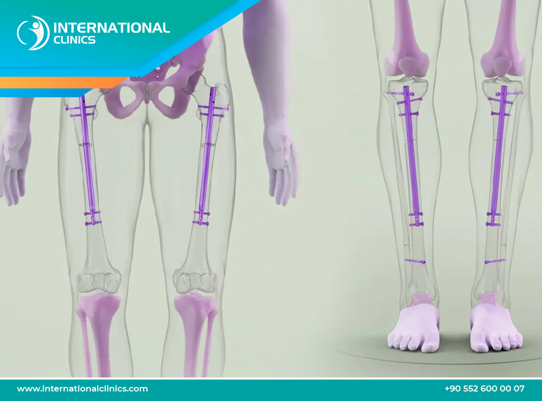 Can You Get Surgery to Be Taller? Limb-Lengthening Surgery