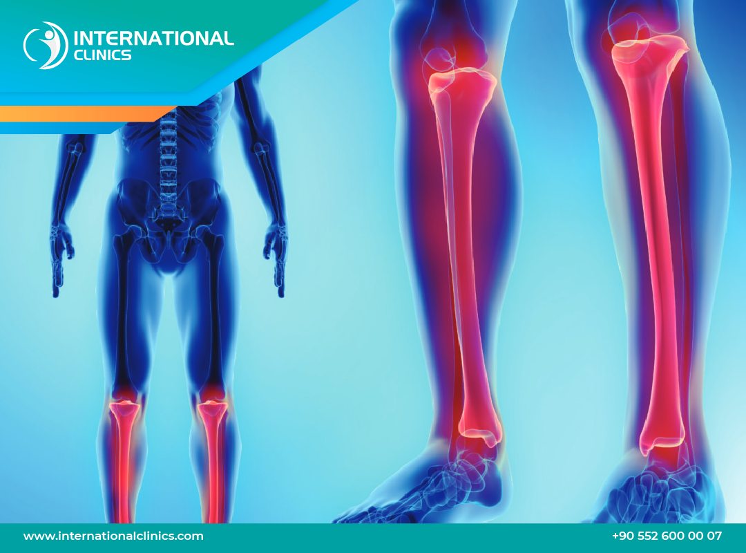 How to Get Taller Surgery: Steps, Cost, and How Effective It Is