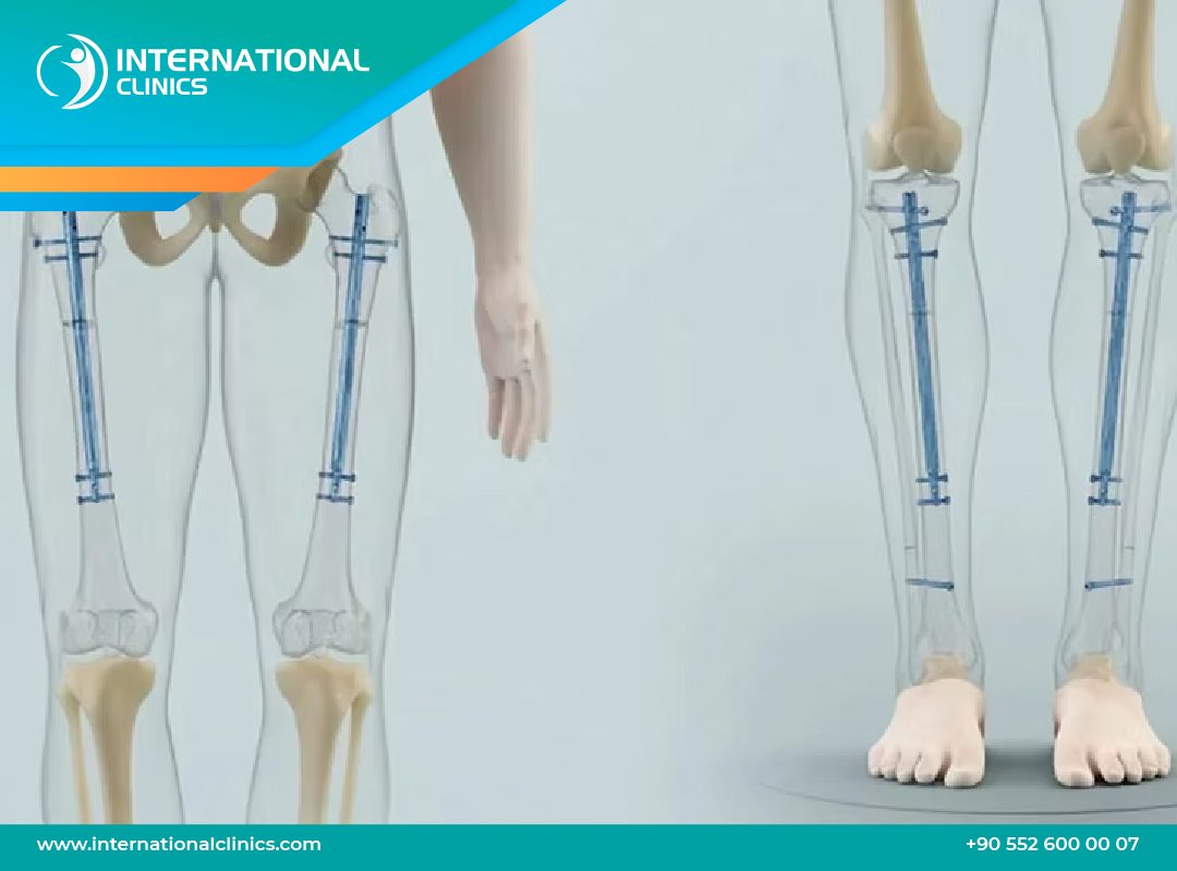 Holyfix limb lengthening: Affordable, strong, and effective height surgery